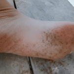 Black-Patches-on-Bottom-of-Feet: Causes and Treatment