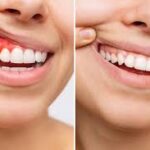 Preventing Tooth Loss: Why Timely Gum Treatment Is Critical