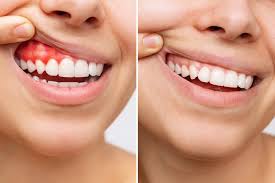 Preventing Tooth Loss: Why Timely Gum Treatment Is Critical