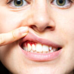 Why Do Your Gums Bleed? Understanding the Root Causes and Solutions