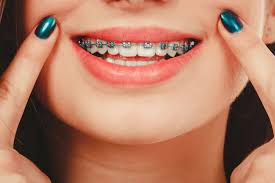 Can Braces Treatment Fix Speech Issues?