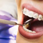 Is Braces Treatment Worth It? Benefits for Oral Health and Confidence