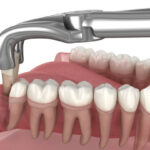 7 Main Reasons Why A Tooth Extraction Might Be Necessary For You