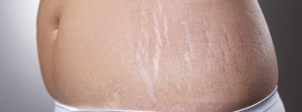 Navigating the Journey of Understanding and Managing Stretch Marks
