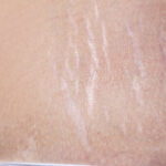 Navigating the Journey of Understanding and Managing Stretch Marks