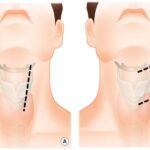 7 Essential Cervical Fusion Scar Guide Tips Revealed