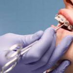 Long-Term Maintenance After Successful Braces Treatment