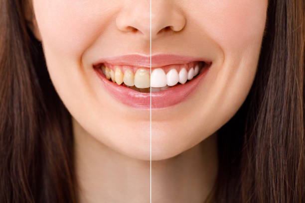 Teeth Whitening in Riyadh: Custom Trays, In-Clinic Systems, and Hybrid Techniques