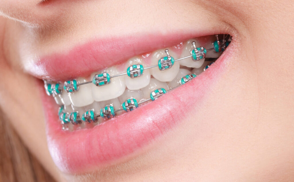 Daily Lifestyle Hacks for Smooth Braces Treatment