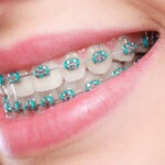 Daily Lifestyle Hacks for Smooth Braces Treatment