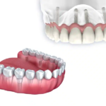 All-on-4 vs Traditional Dental Implants: Which Full-Arch Solution Lasts Longer?