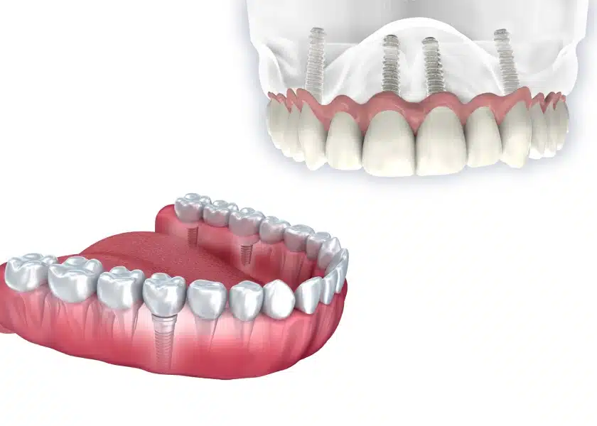 All-on-4 vs Traditional Dental Implants: Which Full-Arch Solution Lasts Longer?