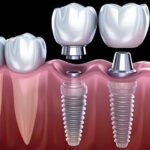 The Best Ways To Find Affordable Dental Implants!