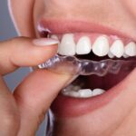 Clear Aligners: A Modern and Comfortable Way to Straighten Your Teeth