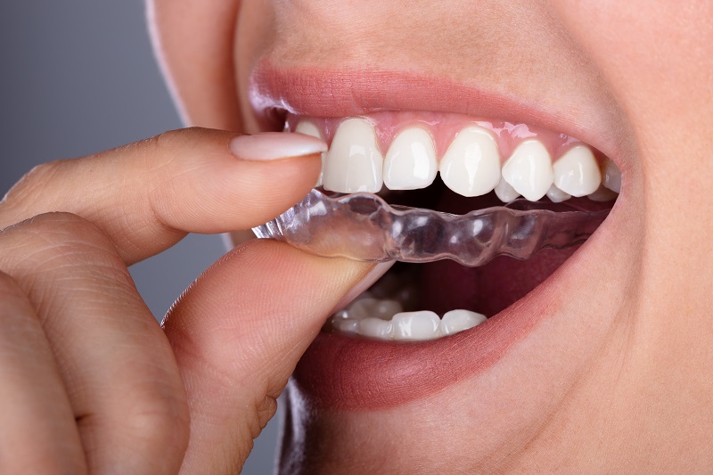 Clear Aligners: A Modern and Comfortable Way to Straighten Your Teeth