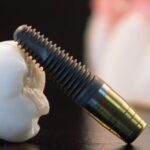 Why Dental Implants Are the Most Reliable Solution for Missing Teeth