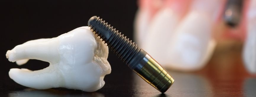 Why Dental Implants Are the Most Reliable Solution for Missing Teeth