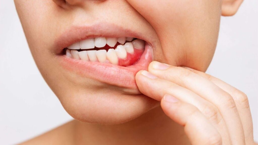 Bleeding Gums: Causes, Treatment, and Why Early Care Matters