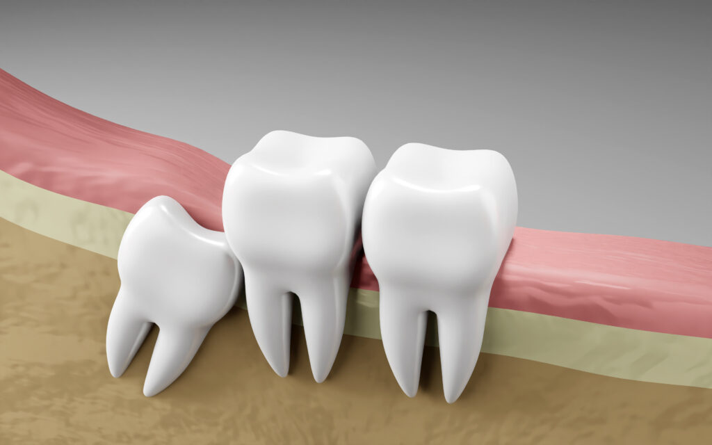 Wisdom Tooth Removal: When and Why It Becomes Necessary