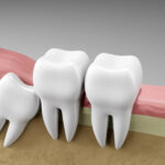 Wisdom Tooth Removal: When and Why It Becomes Necessary