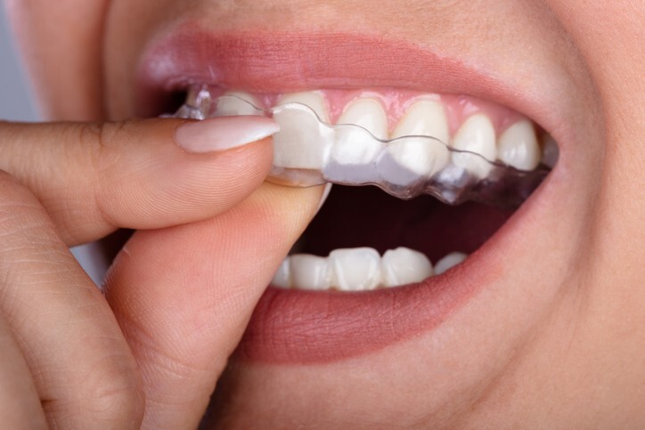 Transforming Your Smile Discreetly: A Modern Guide to Clear Aligners