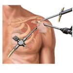 Orthopedics Clinic in Miyapur | Best Orthopedic Surgeon in Madinaguda, Nallagandla Hyderabad – Dr. B. Chakradhar Reddy