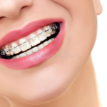 Achieving a Straighter Smile Discreetly: Modern Orthodontics in India