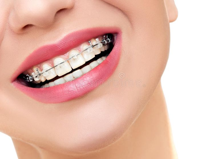 Achieving a Straighter Smile Discreetly: Modern Orthodontics in India