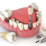 Apollo Dental Clinic in Chandanagar, Kukatpally, Madinaguda and Hyderabad – Dr. John’s Dentistry