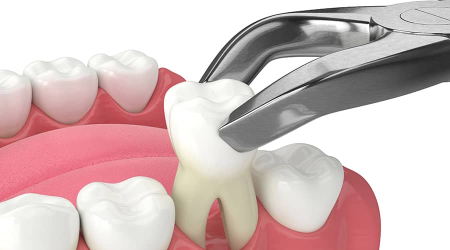 Signs You Need an Affordable Tooth Extraction & When to See a Dentist