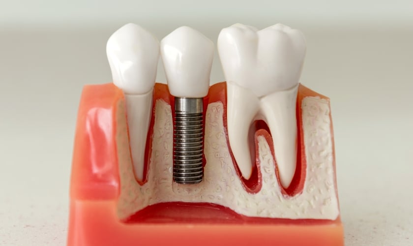 Common Myths About Dental Implant Treatment