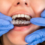 Searching for the Best Invisalign in Navi Mumbai? 5 Questions to Ask Your Dentist