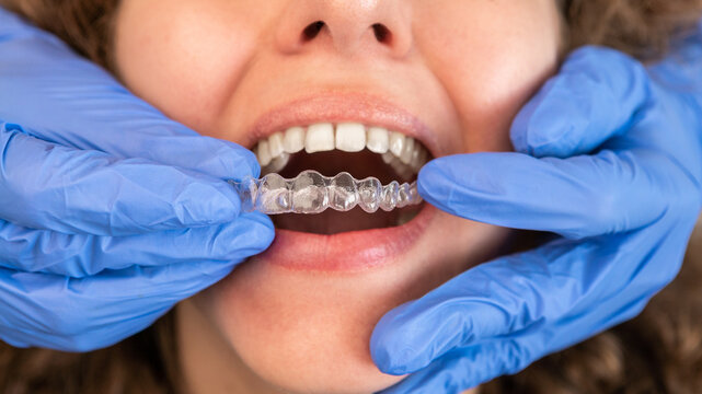 Searching for the Best Invisalign in Navi Mumbai? 5 Questions to Ask Your Dentist