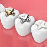 Is a Tooth Colored Filling in Prashant Vihar the Right Choice for Your Cavity?