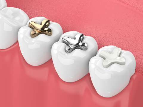 Is a Tooth Colored Filling in Prashant Vihar the Right Choice for Your Cavity?