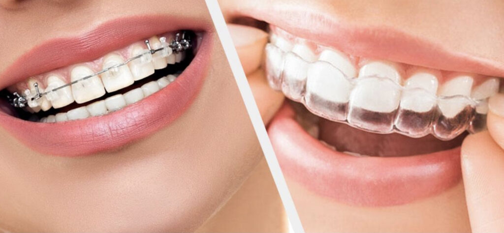 Signs You or Your Child Need Orthodontic Treatment