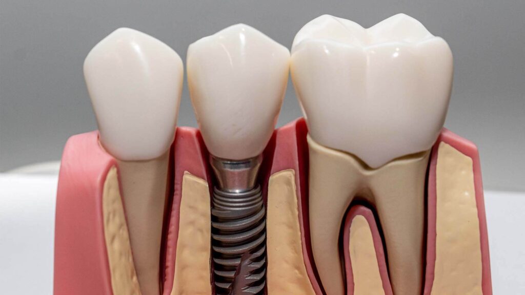 How Do Dental Implants Work And What Are Their Benefits