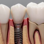 How Do Dental Implants Work And What Are Their Benefits