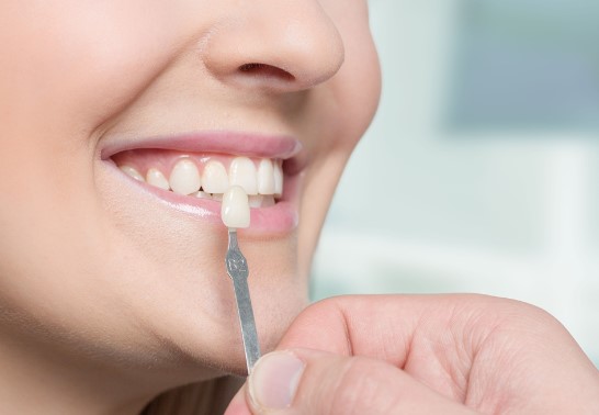 What Is the Complete Veneers Cost Breakdown in Hinjewadi?