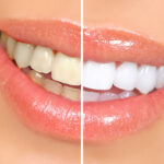 Teeth Whitening Tips for Sensitive Teeth