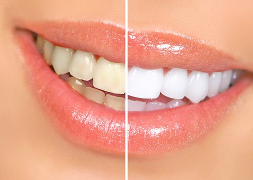 Teeth Whitening Tips for Sensitive Teeth
