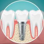 Dental Implant Treatment for Structural Tooth Damage
