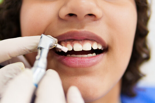 The Importance Of Regular Teeth Cleaning For Oral Health