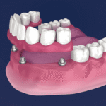 Are Overdentures Comfortable? What Patients Should Know