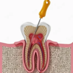 Single Sitting Root Canal Treatment: Fast, Effective & Pain-Relieving Solution