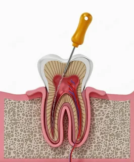 Single Sitting Root Canal Treatment: Fast, Effective & Pain-Relieving Solution