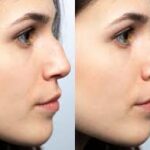 Was kostet Nasenkorrektur ohne OP Zürich?