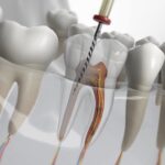 Single-Sitting Root Canal Treatment in Sakkardara: Safe, Precise & Comfortable Care