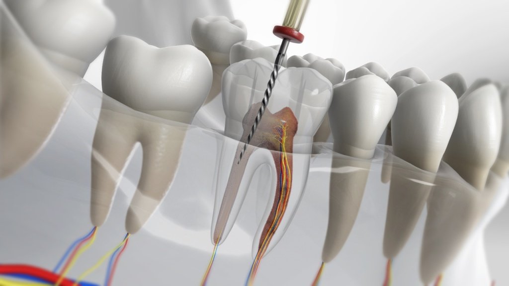 Single-Sitting Root Canal Treatment in Sakkardara: Safe, Precise & Comfortable Care