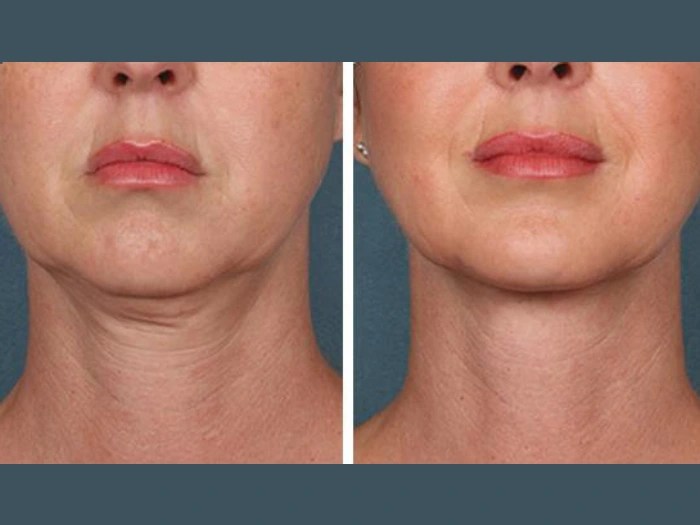 PRP Treatment in Dubai for Early Hair Loss